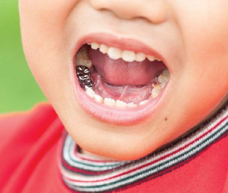 التاج المعدني (SSC) حلّ طويل الأمد لحماية أسنان طفلك